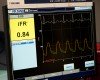 Non-Invasive Technology Is a Money-Saver for Heart Patients Needing PCI