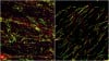 Researchers Identify Rb1 as a Predictive Biomarker for a New Therapeutic Strategy in Some Breast Cancers